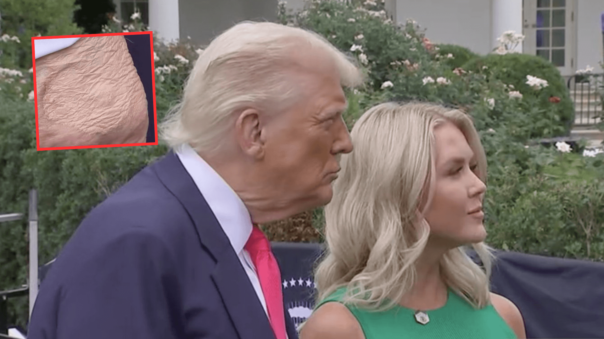 Znów to zauważyli! Tajemniczy ślad na ręce Trumpa zwrócił uwagę dziennikarzy. „Ściska dłonie każdego dnia”