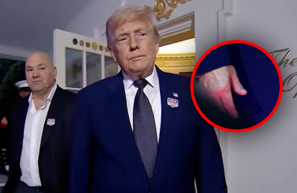 Zobaczyli zdjęcia Trumpa i… Znów TEN ślad na dłoni, od plotek huczy! „Wygląda przerażająco”